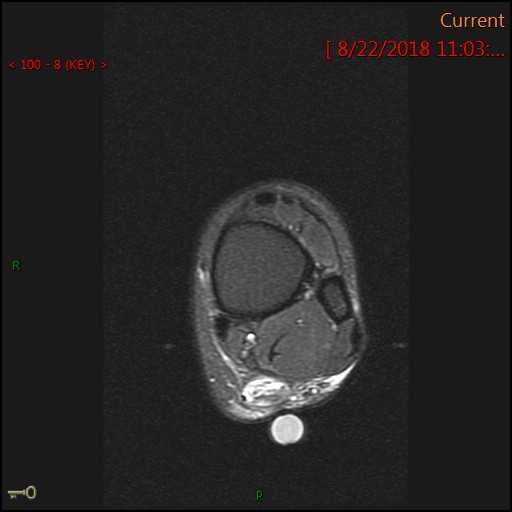 Figure 4 for case Achilles tendon tear and calcaneonavicular coalition (RID3801)(RID3184)